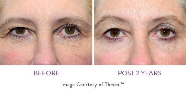 Thermismooth Face Smooth Your Way To Natural Looking Skin The Lumen Center