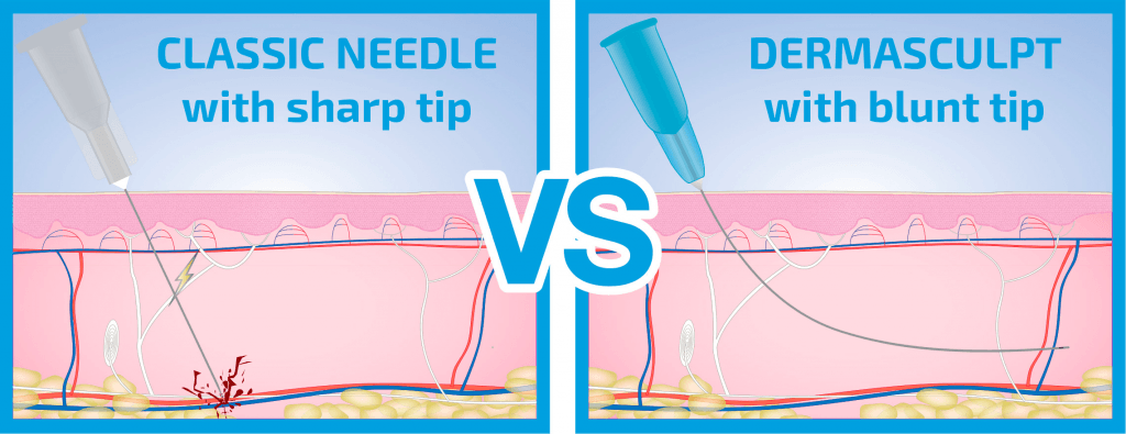 The DermaSculpt microcannula can slide under the skin so the filler can be administered with virtually no pain, swelling and bruising. 