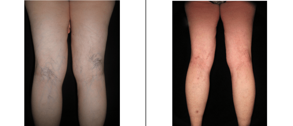 Patient Before and After Sclerotherapy at The Lumen Center