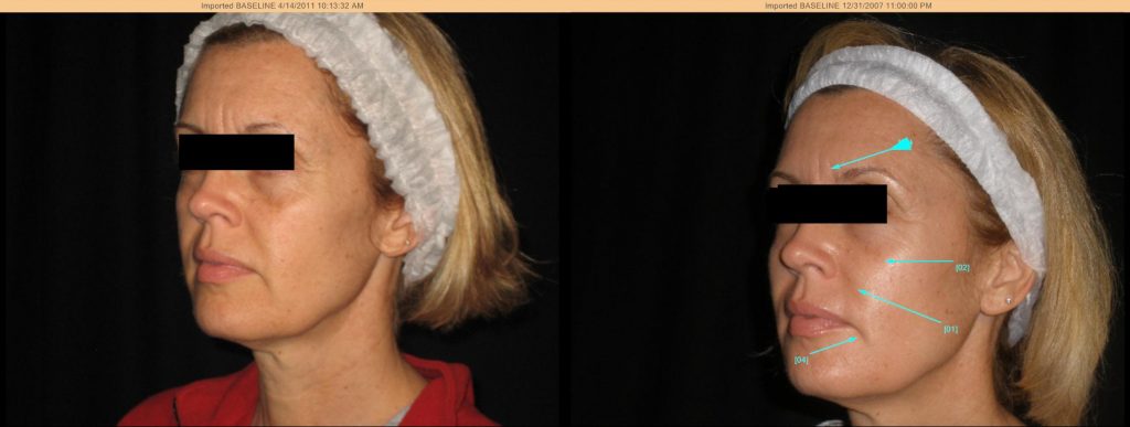 Before and after the Lumen Lift, a nonsurgical, natural facelift