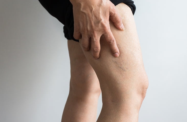 What's The Best Time To Treat Spider & Varicose Veins