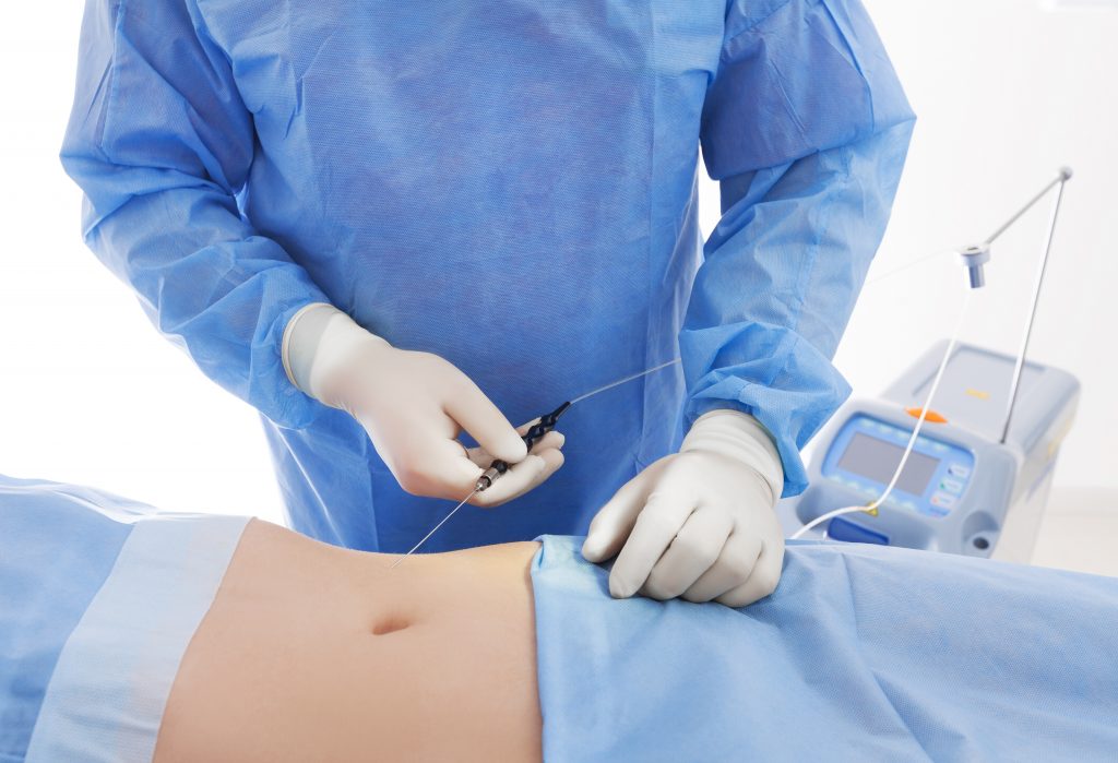 Liposuction