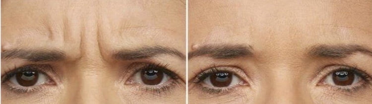 Botox treatment results
