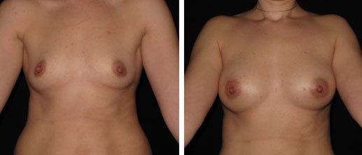 BA breast3 1