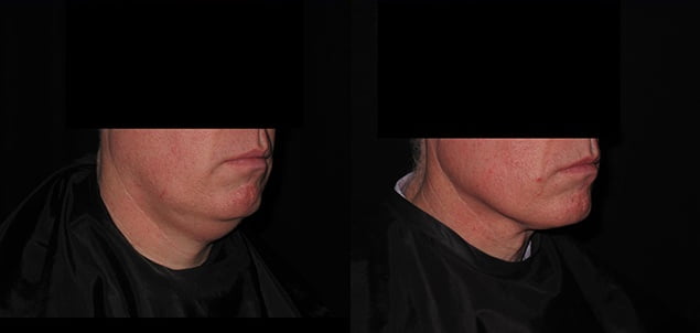 Natural Skin Tightening Treatment Results