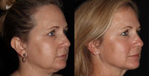 Dramatic before & after results with our Signature Sculpt — So