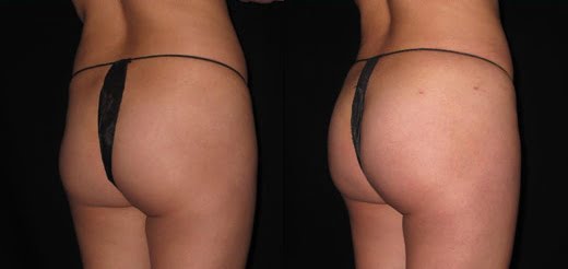 brazilian butt lift results