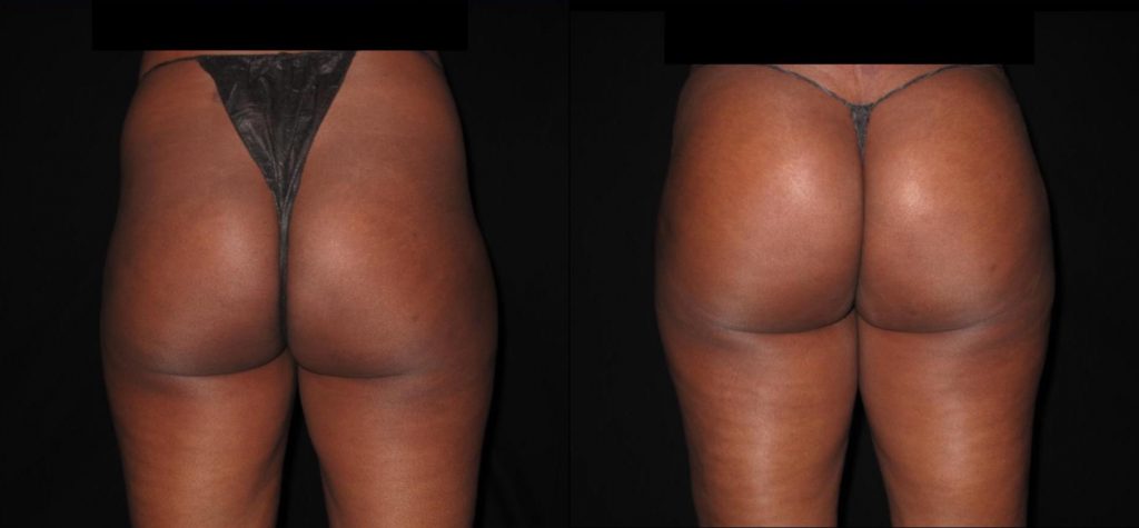 Before and after of Brazilian Butt Lift at The Lumen Center