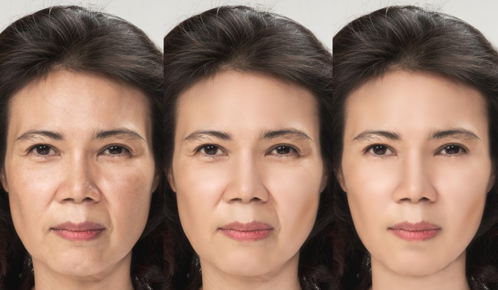 A liquid facelift can reverse the effects of aging