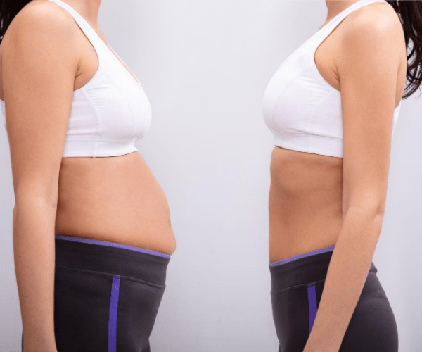 The Liposuction Recovery Timeline: How Your Body Will Transform