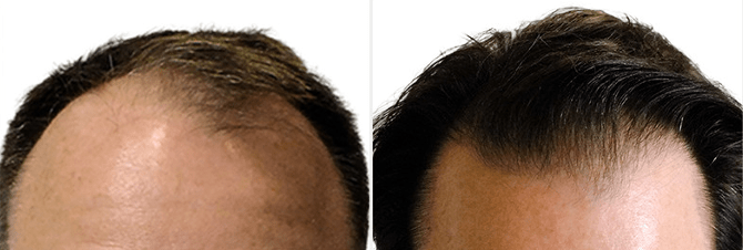 Hair Transplant Philadelphia, PA | Hair Restoration Near ...