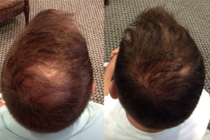 Neograft Hair Transplant Before & After