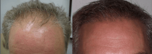 Neograft Hair Transplant | Bryn Mawr, PA