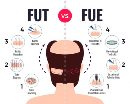 Follicular Unit Extraction Hair Transplant vs. Follicular Unit Transplantation