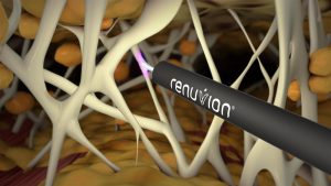 What Is J-Plasma Renuvion?