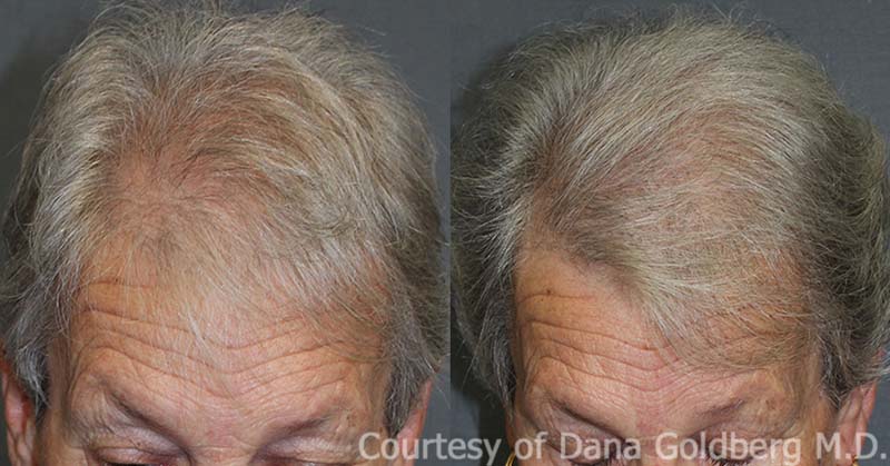 Female Hair Transplant Results