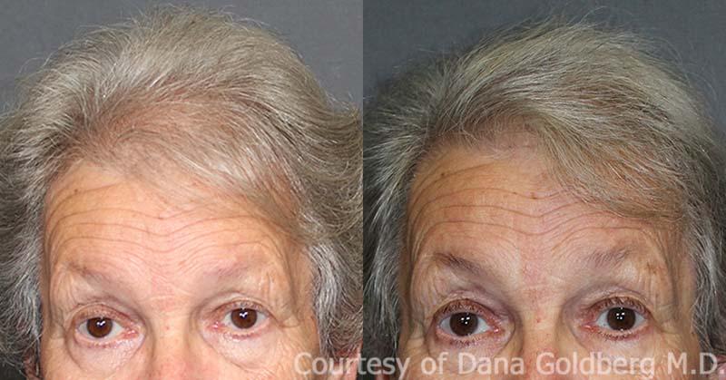 Before and after PRP for women's hair restoration