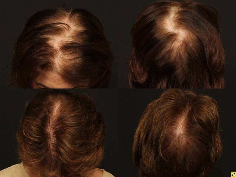 Female Hair Transplantation