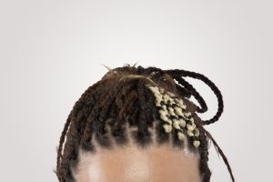 traction alopecia in African Americans, african-american hair transplant