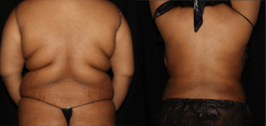 Renuvion J-Plasma Skin Tightening with SmartLipo - Full Back