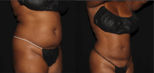 Renuvion Jplasma Body Contouring Before & Afters 01