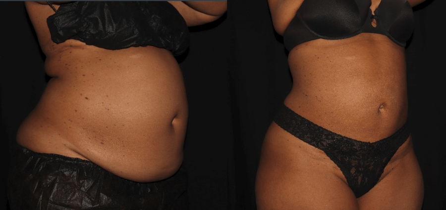 Can You Get a Flat Stomach From Lipo? - Dr. Kadz