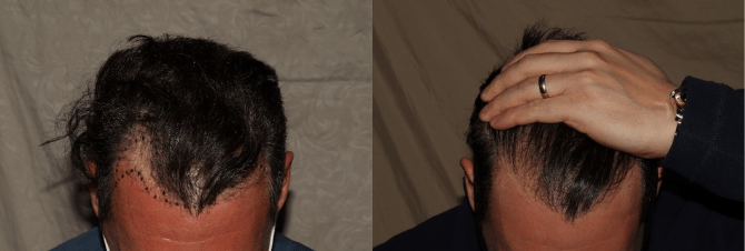 Hair transplant before and after hair transplant in Philadelphia
