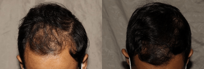 Hair transplant before and after hair transplant in Philadelphia