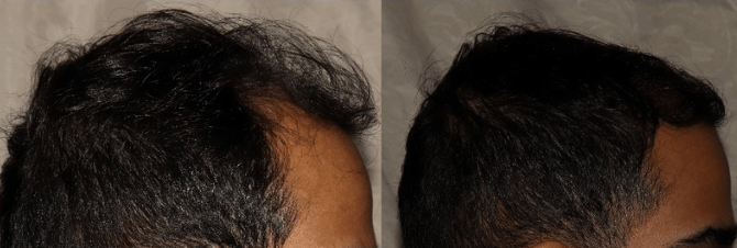 Comparison before and after hair transplant