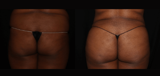 Brazilian butt lift Before & After