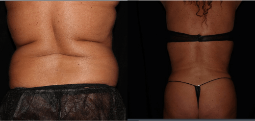 Shape of body after body shaping and butt lift