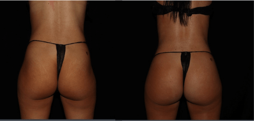 Shape of body after body shaping and butt lift