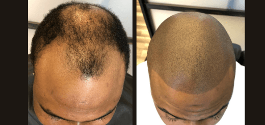 Amazing results after scalp micropigmentation
