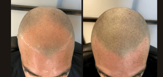 Amazing results after scalp micropigmentation