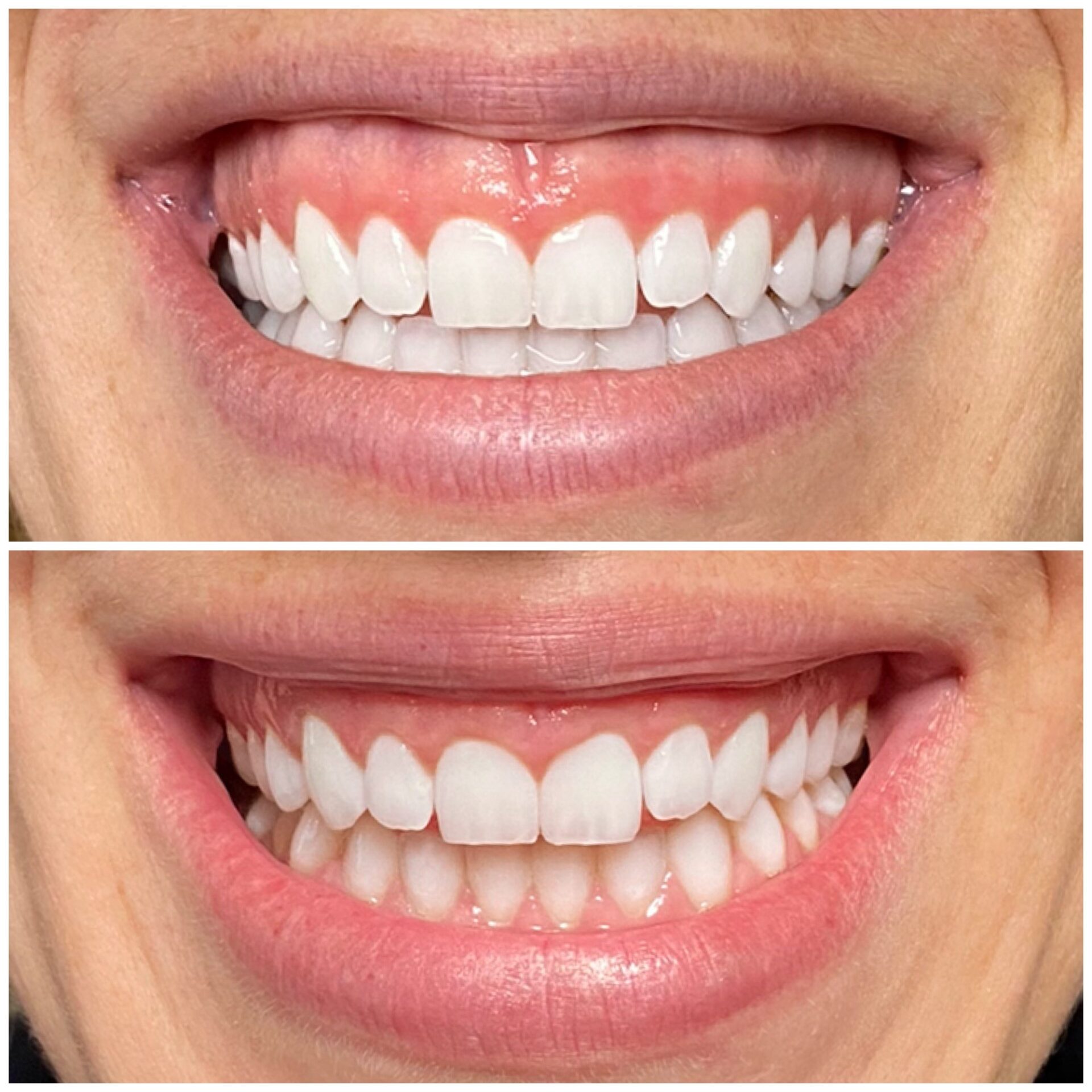 Is a BOTOX Lip Flip Right for You? The Lumen Center Phildelphia