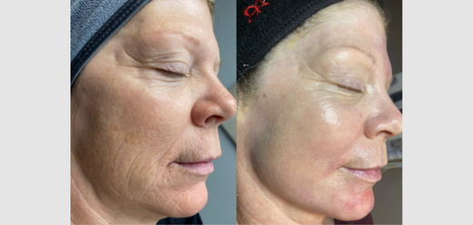 CO2 Fractional Laser Skin Resurfacing Before & After (Updated 2023