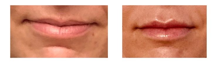Lip filler before and after Bryn Mawr