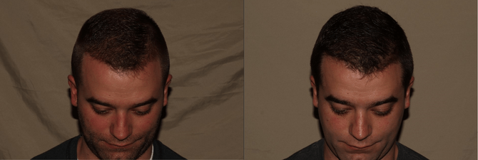 Hair Transplant Philadelphia Before and After