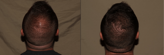 Hair Transplant Before & After Photos | Hair Restoration in Philadelphia, PA