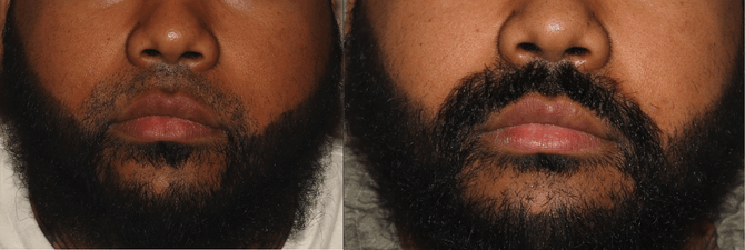 Facial Hair Transplant Philadelphia Before and After