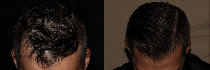 Hair Transplant Philadelphia Before and After