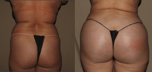 BBL Before and After Philadelphia