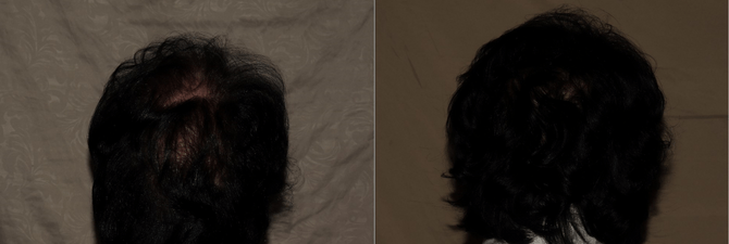 Female Hair Transplant Philadelphia Before and After