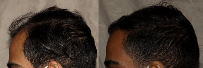 FUE Hair Transplant Philadelphia Before and After