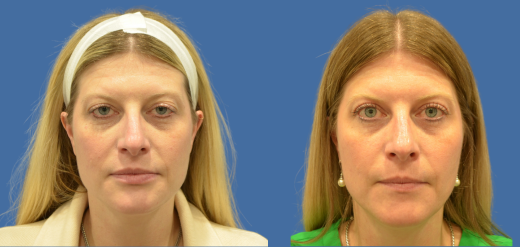eyelid surgery before and after Philadelphia, PA