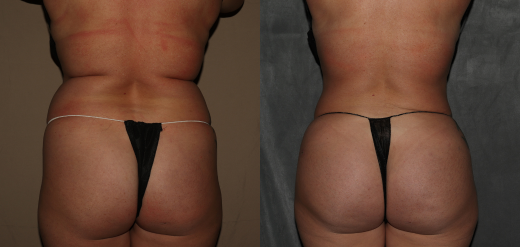 Liposuction and BBL Near Me Philadelphia, PA