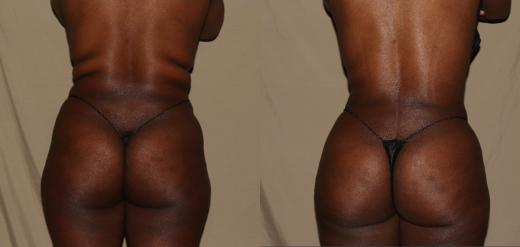 Brazilian Butt Lift Before & After Philadelphia