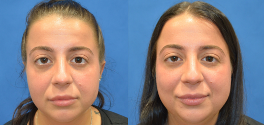 Buccal fat removal before and after