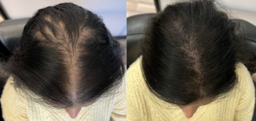 hair loss in women Philadelphia, PA