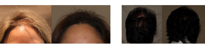 PRP therapy women and hair loss Philadelphia before and after